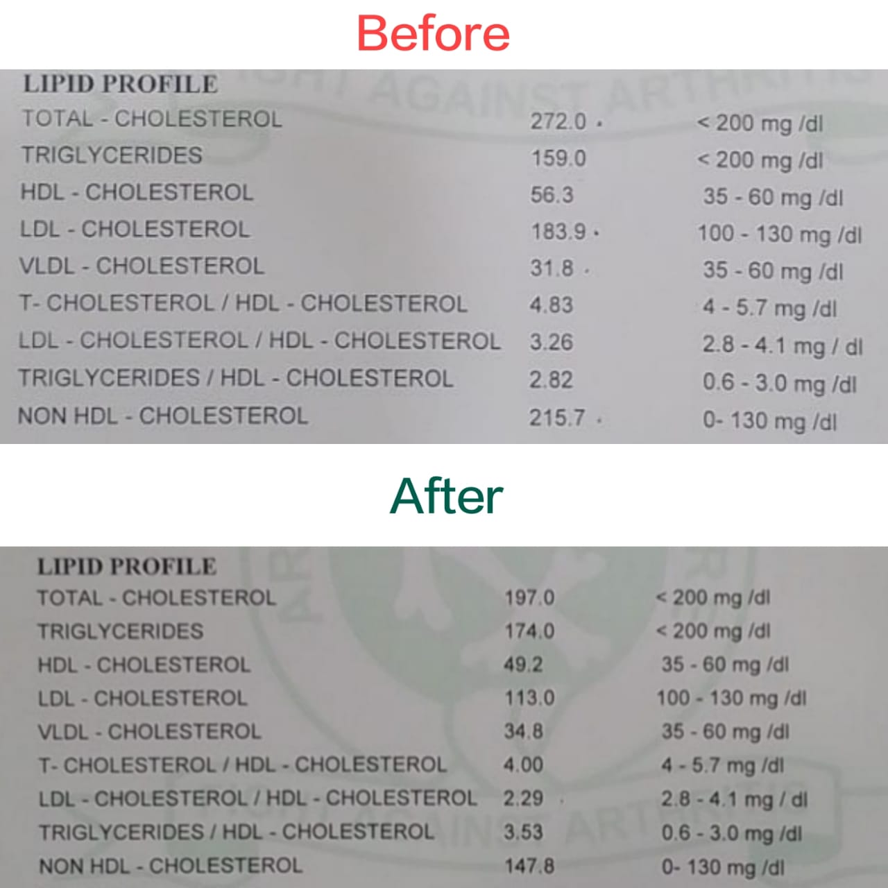 Before and after lipid profile showing cholesterol improvement